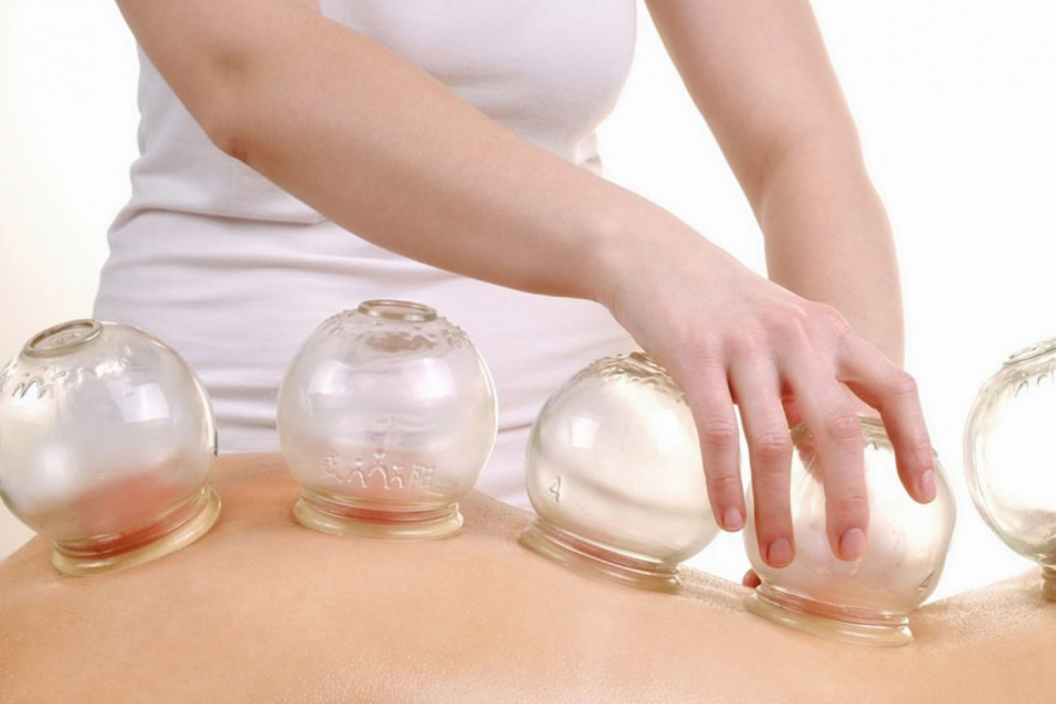 Cupping Therapy