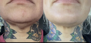 facials before and after done at flawless aesthetics