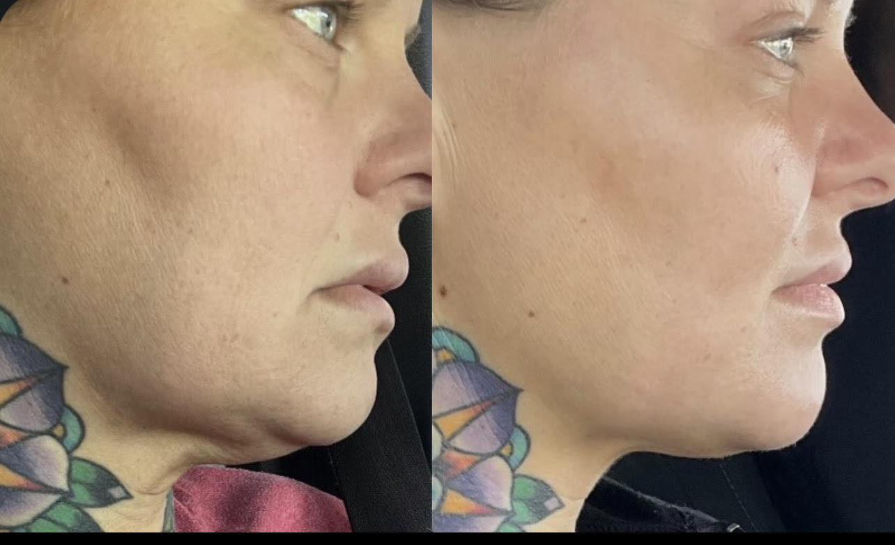 facials before and after done at flawless aesthetics