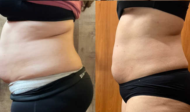 Endospheric Therapy before and after